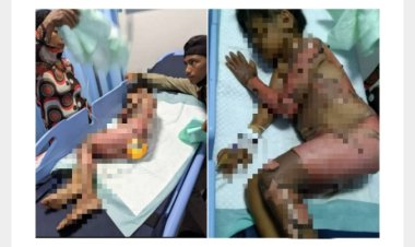 Melepuh Tersiram Air Panas, Zahra Putri Dari Papan Asri, Abung Semuli Lampura Butuh Uluran Tangan