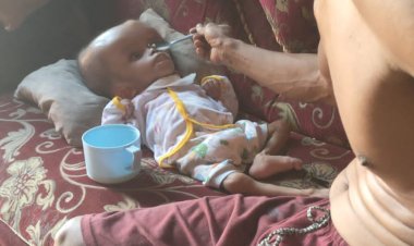 Bocah 7 Tahun di Lamtim Terserang Hidrosefalus Butuh Perhatian Dari Pemerintah