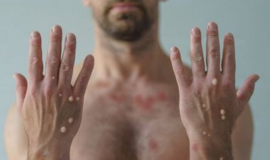 Kemenkes : Waspada Penularan Cacar Monyet