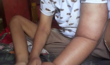 Memilukan! Keadaan Kasirah Penderita Kanker Payudara Stadium 3