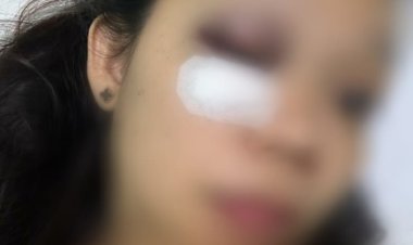 Ungkap Perselingkuhan Suami Berprofesi Polri, Istri Nyaris Buta Dianiaya 